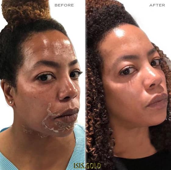 african american black female woman with peeling skin around her mouth after a tca chemical peel and showing after her skin healed