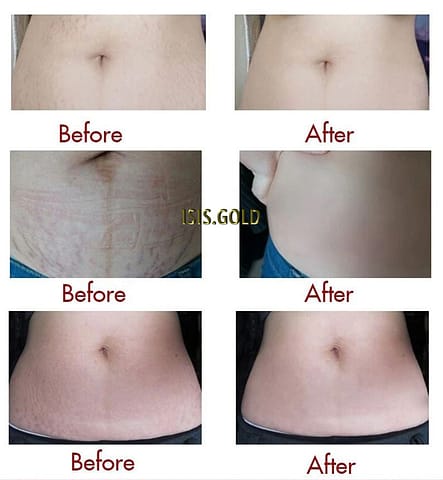women with stretchmarks on belly before and after stretch marks removal
