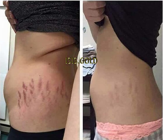 woman with stretchmarks on belly love handles before and after stretch marks removal