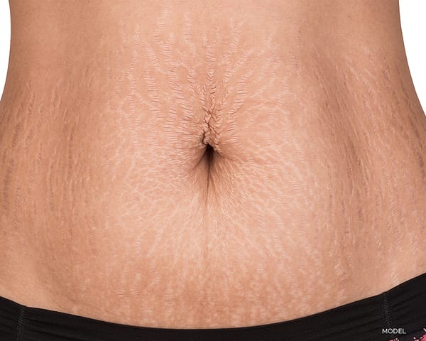 Black Woman With Stretchmarks on Belly