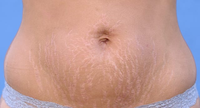 Spanish Woman With Stretchmarks on Belly